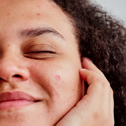 Pore Perfect Bundle: Balancing Facial Essentials for Acne-Prone and Oily Skin ($10 Donated to Heart&Stroke)